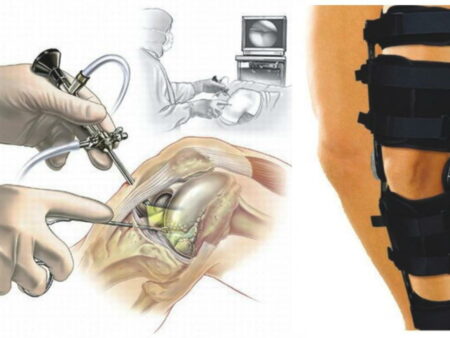 Травма Бремера: операция на мениске левого колена и сроки восстановления